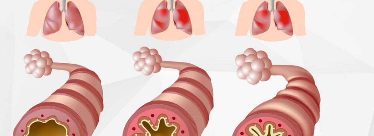 How To Survive An Asthma Attach Without an Inhaler